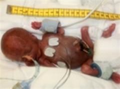 Der frühgeborene Junge fünf Tage nach seiner Geburt im Sommer 2009.